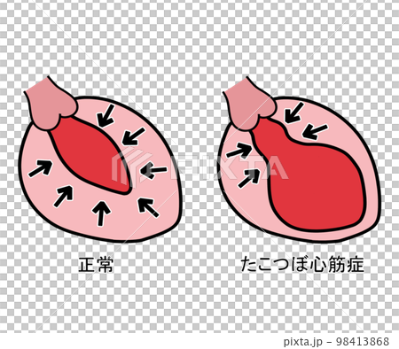 たこつぼ型心筋症 98413868