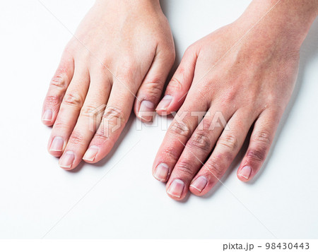 しもやけ・あかぎれで腫れた女性の手 98430443