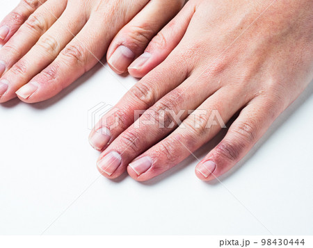 しもやけ・あかぎれで腫れた女性の手 98430444