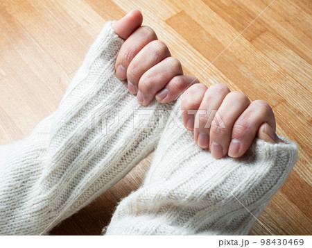 しもやけ・あかぎれで腫れた女性の手 しもやけ・あかぎれで腫れた女性の手 98430469