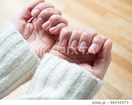 しもやけ・あかぎれで腫れた女性の手 98430473