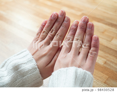 しもやけ・あかぎれで腫れた女性の手 98430528