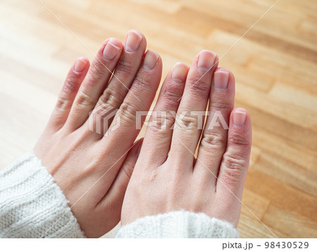 しもやけ・あかぎれで腫れた女性の手 98430529