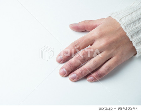 しもやけ・あかぎれで腫れた女性の手 98430547