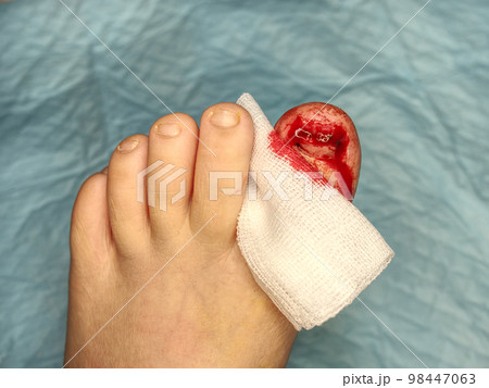 Torn bloody fingernail on young girl's toe covered with sterile gauze Torn bloody fingernail on young girl's toe covered with sterile gauze 98447063