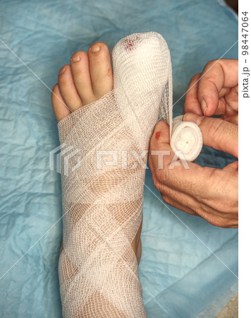 Helping to injured and cut toe and toe nail with blood soaking bandage. Helping to injured and cut toe and toe nail with blood soaking bandage. 98447064