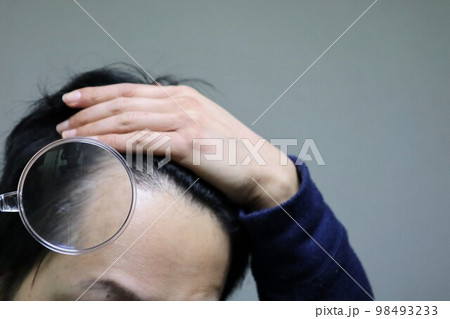 薄毛に悩む日本人男性 98493233