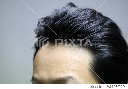 薄毛の日本人男性	 98493709