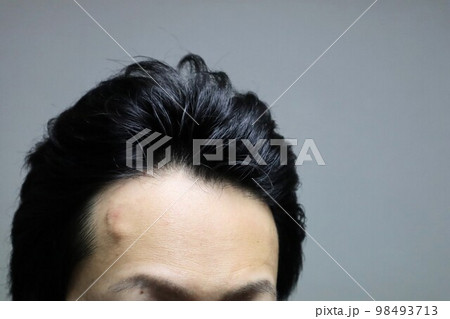 薄毛の日本人男性	 98493713