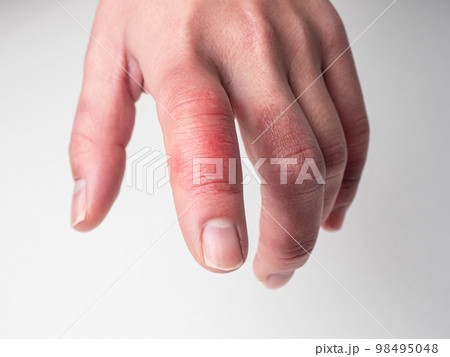 しもやけ 怪我で腫れた手の指 98495048