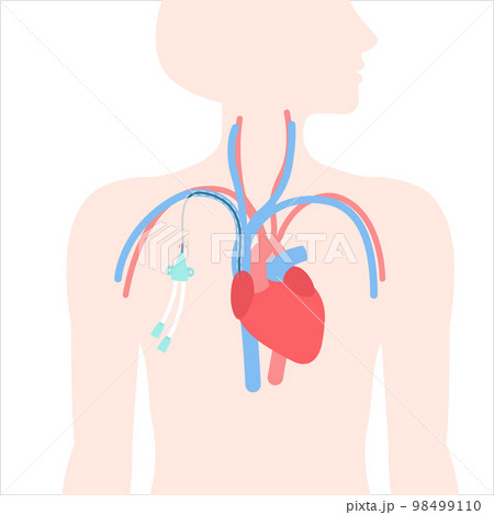 Tunneled central line venous catheter medical diagram 98499110