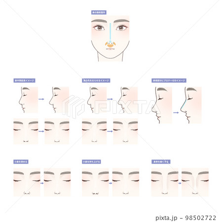 鼻の整形図解セット 鼻の整形図解セット 98502722
