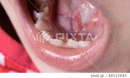 Crooked teeth in a child's mouth. The permanent tooth grows next to the milk tooth, close-up 98525693