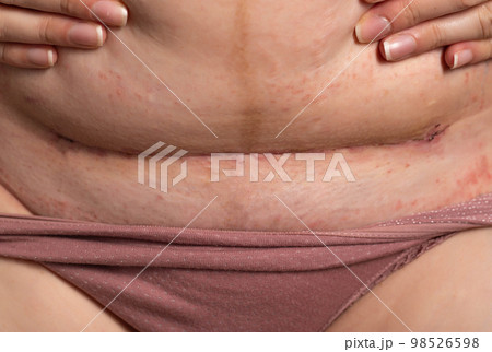 The seam on the abdomen of a woman after a caesarean section. Recovery of the female body after the birth of a child, complications. Close-up, postponed The seam on the abdomen of a woman after a caesarean section. Recovery of the female body after the birth of a child, complications. Close-up, postponed 98526598