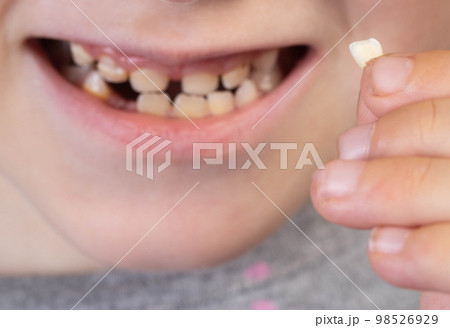 The child holds a milk tooth incisor in his hand. Extraction of milk teeth in children. Children's dentistry. Close-up 98526929