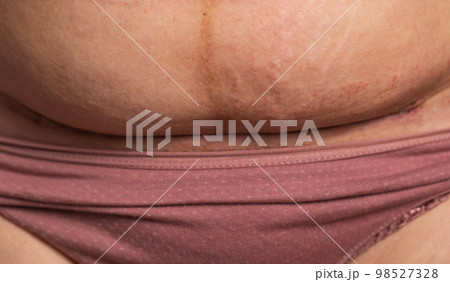 The seam on the abdomen of a woman after a caesarean section. Recovery of the female body after the birth of a child, complications. Close-up, postponed The seam on the abdomen of a woman after a caesarean section. Recovery of the female body after the birth of a child, complications. Close-up, postponed 98527328