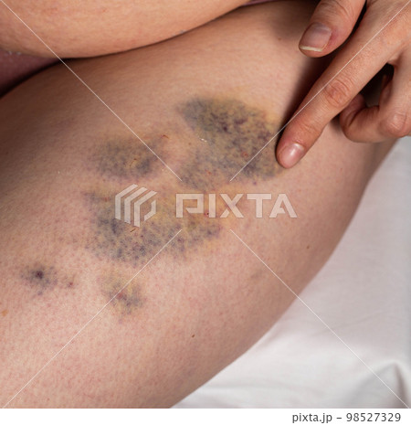Treatment of bruises, bumps and seals after injections with therapeutic ointment. Rubbing a medicinal ointment into the injection and bruising sites. Close-up Treatment of bruises, bumps and seals after injections with therapeutic ointment. Rubbing a medicinal ointment into the injection and bruising sites. Close-up 98527329