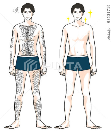 体毛が多い男性のビフォーアフターのイラスト 体毛が多い男性のビフォーアフターのイラスト 98531719