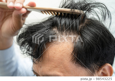 Bald in the head and begin no loss hair glabrous of mature Asian business smart active office man. Bald in the head and begin no loss hair glabrous of mature Asian business smart active office man. 98543225