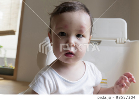顔に虫刺され跡が沢山ある2歳の男の子の顔アップの写真素材 [98557304] - PIXTA