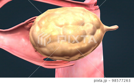 The ovaries are small, oval-shaped glands located on either side of your uterus. 98577263