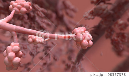 The bronchial occlusion causes air to be sucked from distal lung tissue and therefore this area shrinks and collapses 98577378