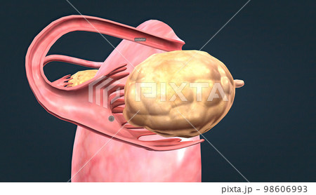 The ovaries are small, oval-shaped glands located on either side of your uterus. 98606993
