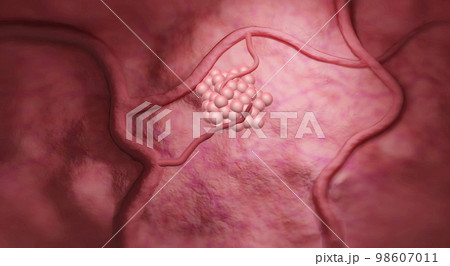 Lung cancer is caused by uncontrolled growth of harmful cells in our lungs. 98607011