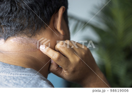 Dark-skinned Asian men suffer from scalp dermatitis due to moisture-causing fungi. fungal itching. skin diseases-allergies, psoriasis, eczema, dermatitis. Dark-skinned Asian men suffer from scalp dermatitis due to moisture-causing fungi. fungal itching. skin diseases-allergies, psoriasis, eczema, dermatitis. 98619006