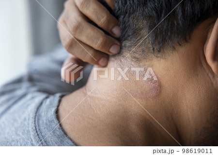 Dark-skinned Asian men suffer from scalp dermatitis due to moisture-causing fungi. fungal itching. skin diseases-allergies, psoriasis, eczema, dermatitis. Dark-skinned Asian men suffer from scalp dermatitis due to moisture-causing fungi. fungal itching. skin diseases-allergies, psoriasis, eczema, dermatitis. 98619011
