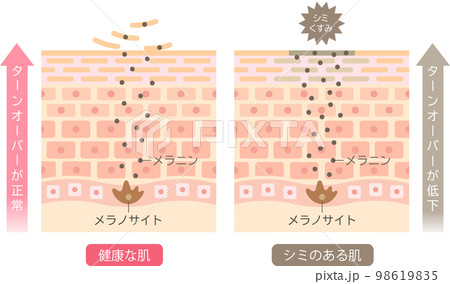 シミのできる肌のしくみ　ターンオーバー　肌細胞　ビフォアアフター 98619835