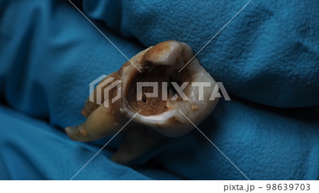 Tooth decay and dentist hand with glove and black background. Macro shot of a decayed teeth till root after extraction of dentist. Real tooth anatomy due lack of dental care. Top view of caries teeth 98639703