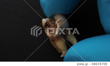 Tooth decay and dentist hand with glove and black background. Macro shot of a decayed teeth till root after extraction of dentist. Real tooth anatomy due lack of dental care. Top view of caries teeth 98639706
