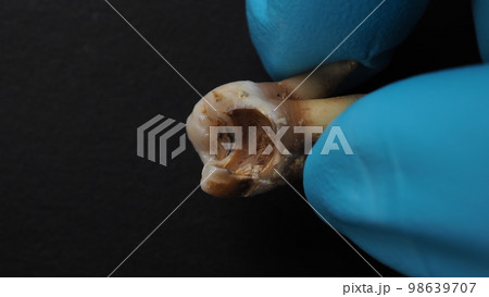 Tooth decay and dentist hand with glove and black background. Macro shot of a decayed teeth till root after extraction of dentist. Real tooth anatomy due lack of dental care. Top view of caries teeth 98639707