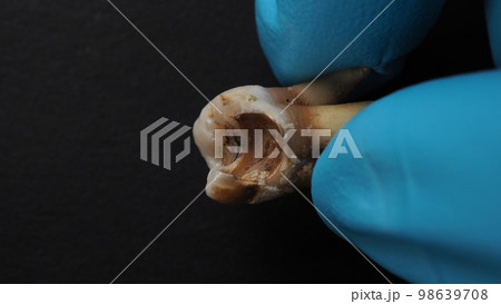 Tooth decay and dentist hand with glove and black background. Macro shot of a decayed teeth till root after extraction of dentist. Real tooth anatomy due lack of dental care. Top view of caries teeth 98639708