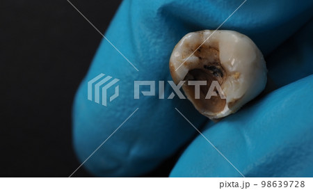 Tooth decay and dentist hand with glove and...の写真素材 [98639728] - PIXTA