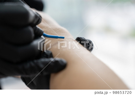 Dermatologist removes a mole on a patient's arm using an electrocoagulator. Dermatologist removes a mole on a patient's arm using an electrocoagulator. 98653720