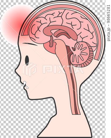 人体の脳の断面図にくも膜下出血や頭痛などの痛み 人体の脳の断面図にくも膜下出血や頭痛などの痛み 98665281