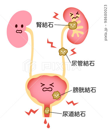 尿路結石でつらそうな腎臓と膀胱のイラスト　名称あり 98680023