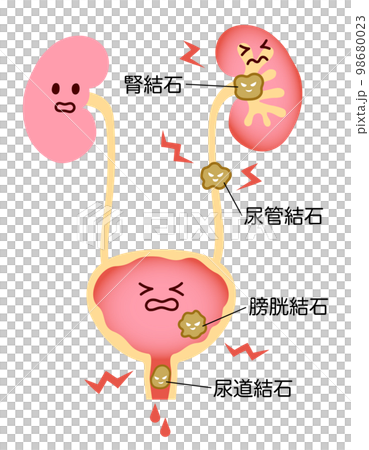 尿路結石でつらそうな腎臓と膀胱のイラスト　名称あり 98680023
