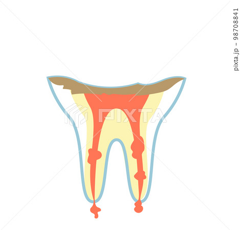 C4の虫歯 98708841