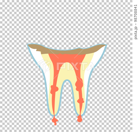 C4の虫歯 98708841