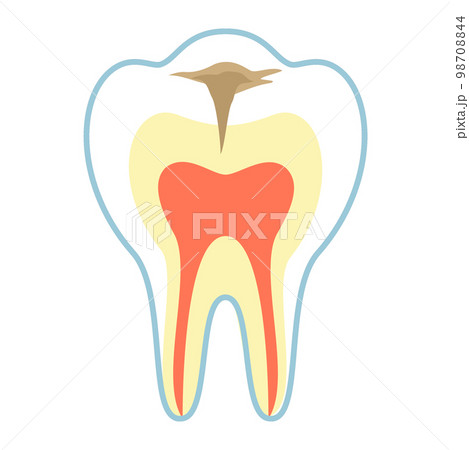 C2の虫歯 98708844