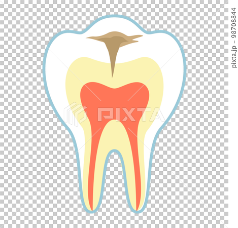C2の虫歯 98708844