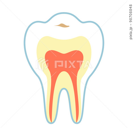 C0の虫歯 98708848