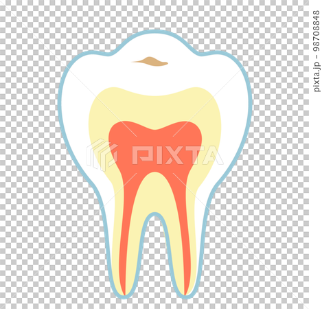 C0の虫歯 98708848