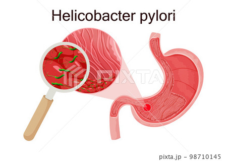 Gastritis caused by helicobacter pylori in stomach under magnifying glass Gastritis caused by helicobacter pylori in stomach under magnifying glass 98710145