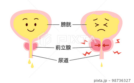 正常と前立腺肥大の説明比較イラスト 98736327