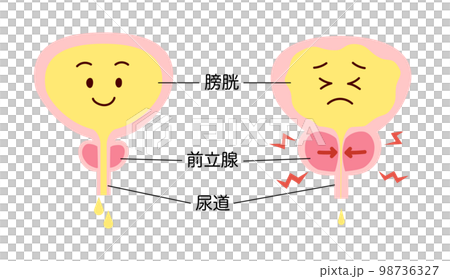 Explanation comparison illustration of normal and enlarged prostate 98736327