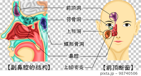 副鼻腔　構造　イラスト　中国語 98740506
